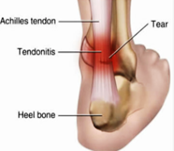 Achilles Tendon Pain Sydney Foot Clinic