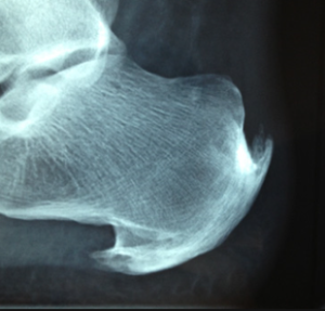 Dry Needling And Plantar Fasciitis / Unilateral Hip Flexion Stretch - G4 Physiotherapy & Fitness : Plantar fasciitis is a painful inflammation of the plantar fascia, a fibrous band of tissue on the bottom of the foot that helps to support the arch.
